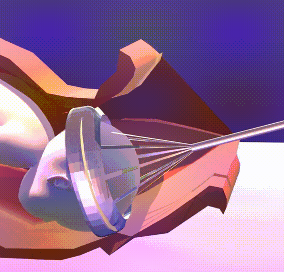 &amp;amp;amp;lt;em&amp;amp;amp;gt;PeriAssist&amp;amp;amp;lt;/em&amp;amp;amp;gt;&amp;amp;amp;lt;em&amp;amp;amp;gt; is designed to be a safer alternative to existing tools used in assisted vaginal delivery.&amp;amp;amp;lt;/em&amp;amp;amp;gt;