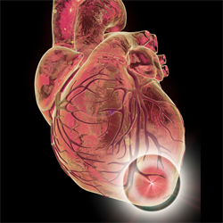 &amp;amp;lt;em&amp;amp;gt;Illustration of myocardial infarction.&amp;amp;lt;/em&amp;amp;gt;