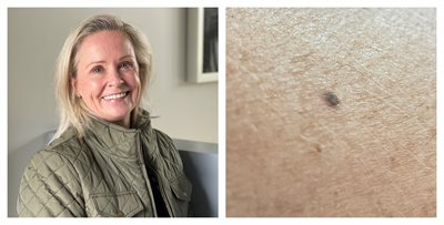 Left: Deana McDonagh. Right: Freckle found on her arm.