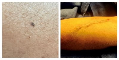 Left: Freckle on McDonagh&rsquo;s arm. Right: Scar after surgery.