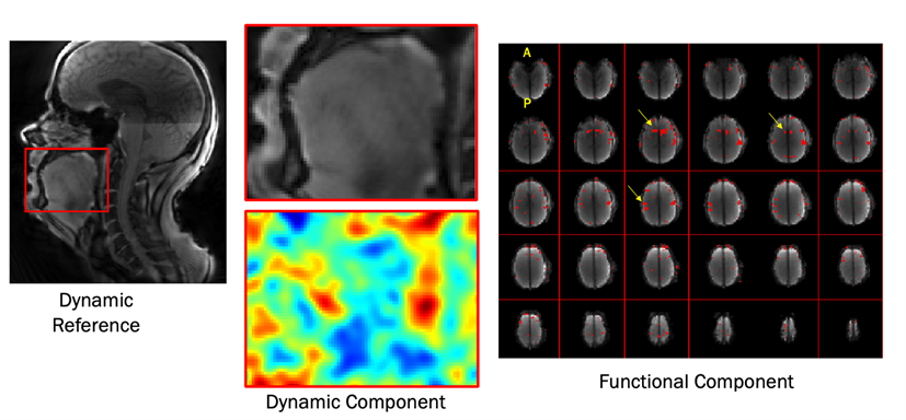 This figure shows the imaging that is possible with SimulScan. A dynamic image of swallowing is obtained, similar to the image on the left. The middle panel zooms in on the tongue, lips, and pharynx, which will have swallowing motion that the team is interested in. In the right-hand panel is brain function associated with swallowing, showing activations in muscle control regions associated with the tongue and lips, indicated by arrows. The bottom, middle panel shows the regions in the dynamic image that are correlated with those brain activations, showing movement of the base of the tongue and top of the tongue dorsum as dynamic regions impacted by the brain activity shown.