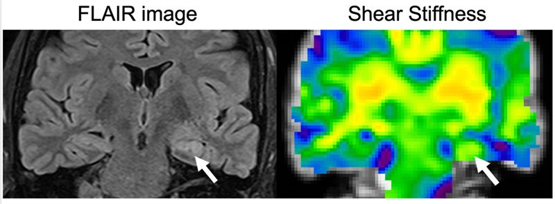 This is an example of the type of image being produced in Professor Sutton's lab. A FLAIR image, left, that is conventionally used to show what part of the brain is impacted by the disease, is shown with the corresponding MRE stiffness map from the patient showing stiffness changes due to disease. The affected side is indicated by the arrow. 